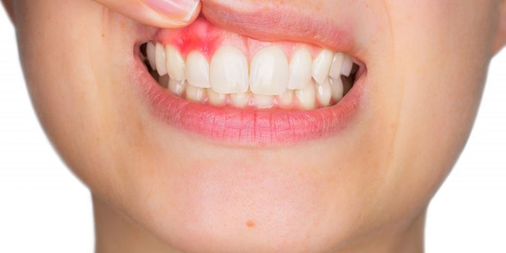 歯茎から膿が出る原因と応急処置