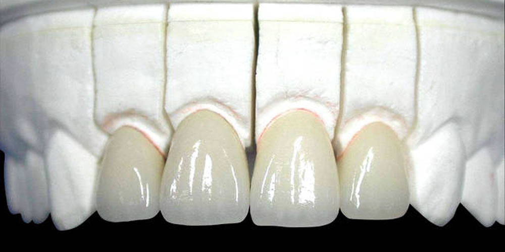 セラミックの歯の寿命が短くなってしまう要因
