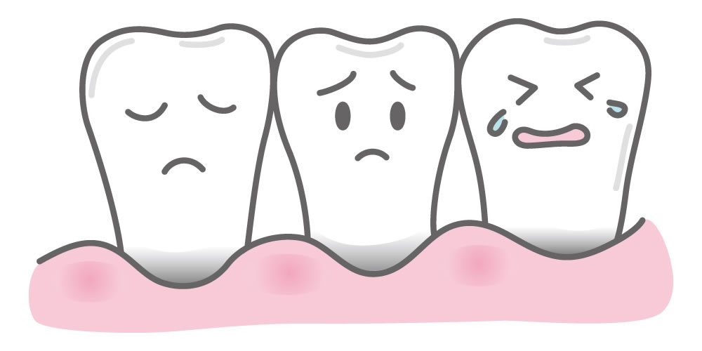 歯茎が下がる歯肉退縮の原因