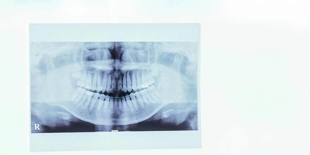 歯科医院で行うレントゲン撮影で確認できるもの