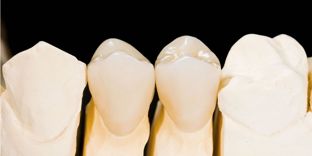 インプラント治療中の仮歯の役割