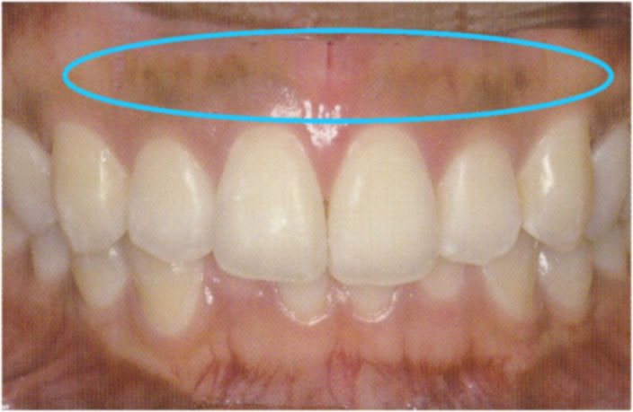 歯茎のホワイトニングbefore