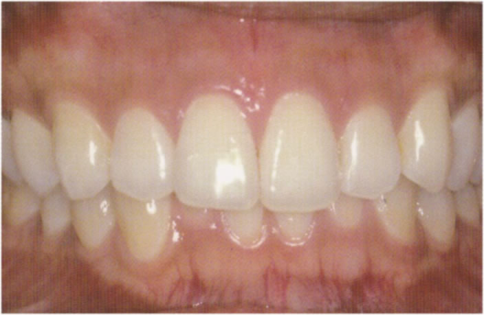 歯茎のホワイトニングafter